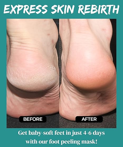 CHAMOS ACACI - Monster Foot Peeling Pack 1pz