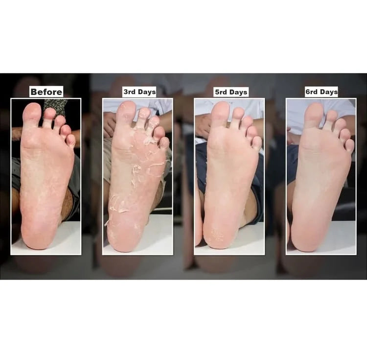 CHAMOS ACACI - Monster Foot Peeling Pack 1pz