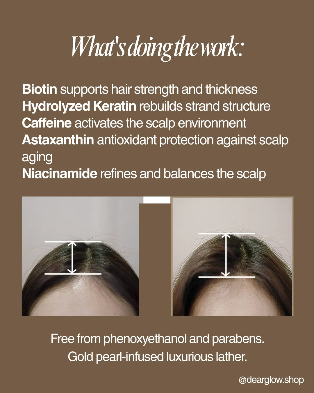 Promotional graphic for a hair scalp treatment with text detailing ingredients and before/after scalp width measurements on two women's foreheads, set against a brown background.